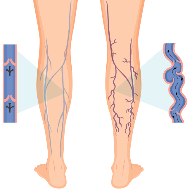 Лечение варикоза