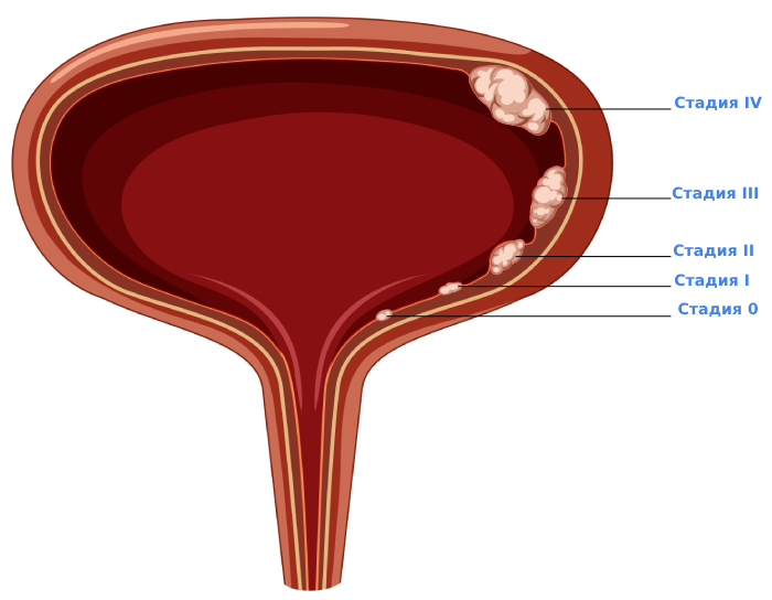 Рак мочевого пузыря симптомы