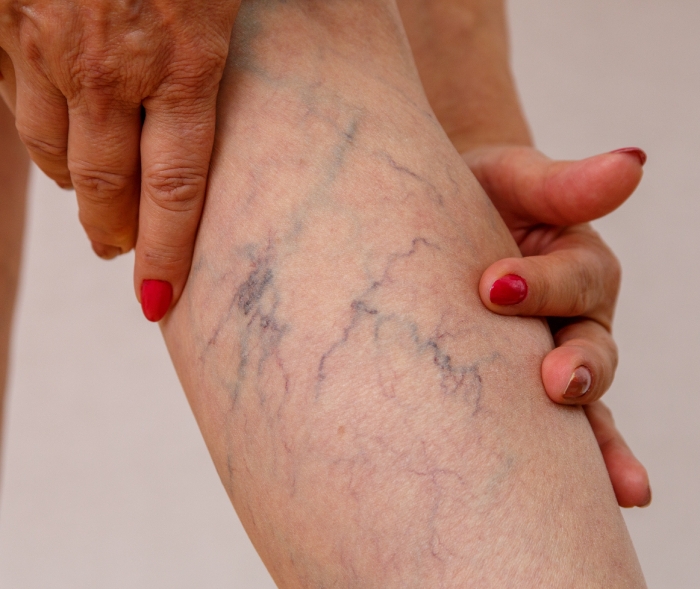 Варикоз на ногах лечение