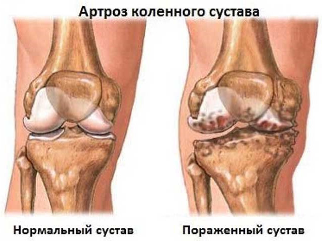 Артроз коленного сустава: причины, симптомы, лечение в ФНКЦ ФМБА