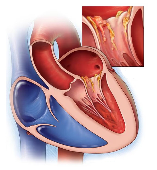 Эндокардит клапана Эндокардит клапана