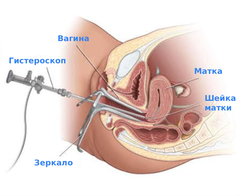 Гистероскопия матки Гистероскопия матки
