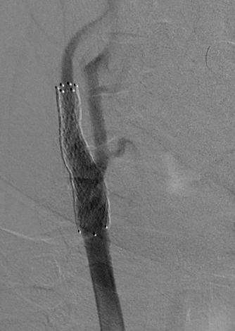 Стентирование - операция -2