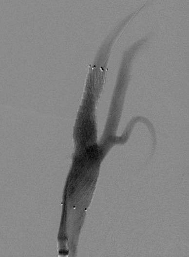 Стентирование - операция -1