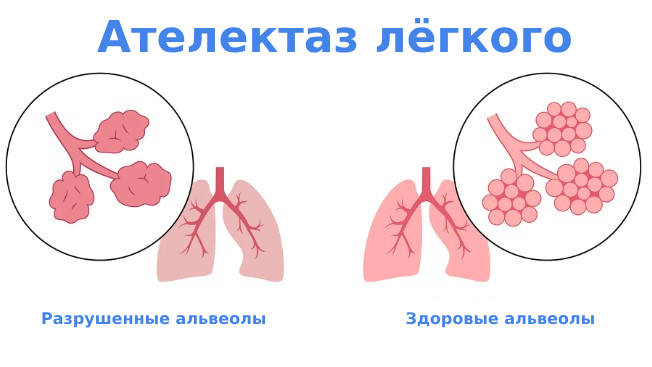 Ателектаз легких причины и лечение Ателектаз легких причины и лечение