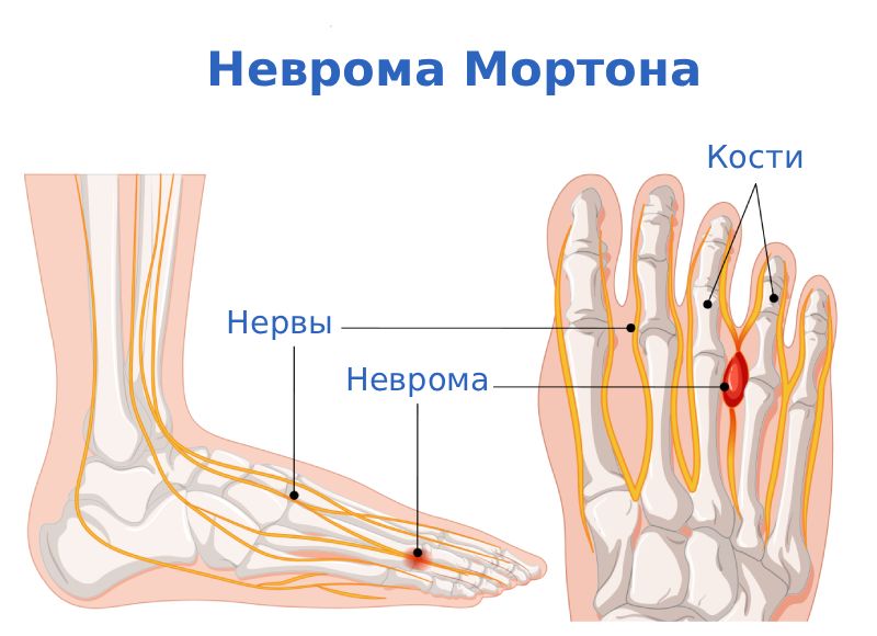 Неврома Мортона симптомы Неврома Мортона симптомы