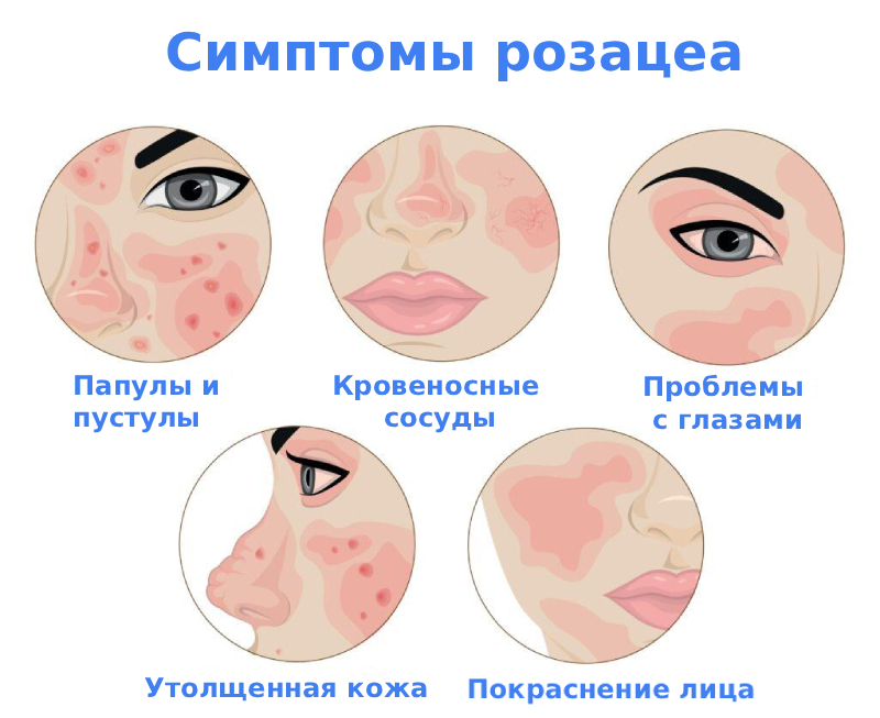Розацеа на лице Розацеа на лице