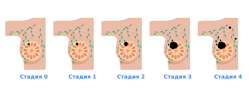 Стадии рака молочной железы