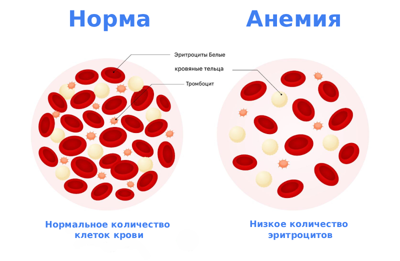 Анемия симптомы Анемия симптомы