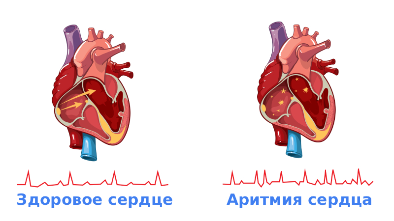 Аритмия сердца