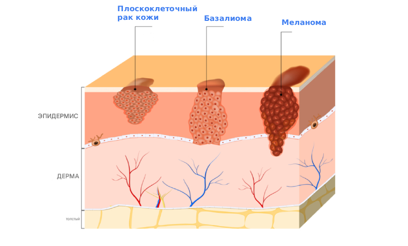 Базальноклеточный рак кожи Базальноклеточный рак кожи
