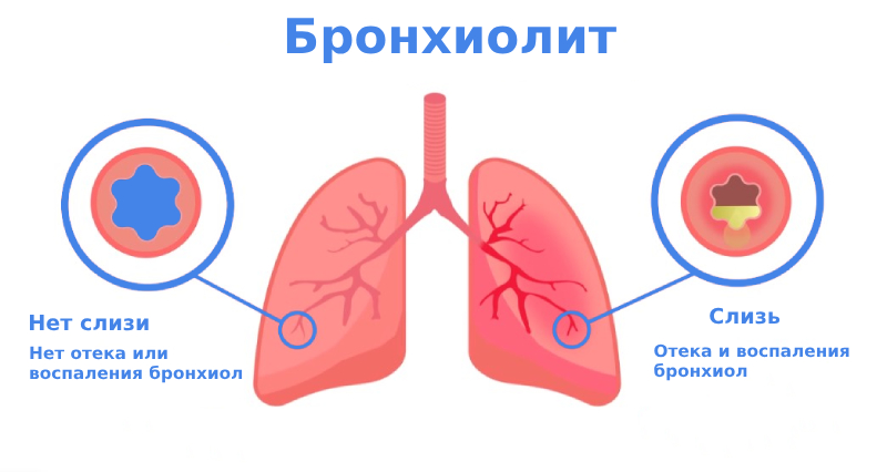 Бронхиолит симптомы и лечение