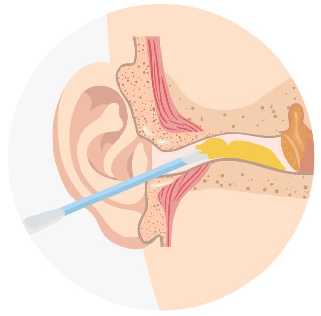 Удаление серной пробки Удаление серной пробки