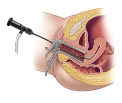 Диагностика рака матки Диагностика рака матки