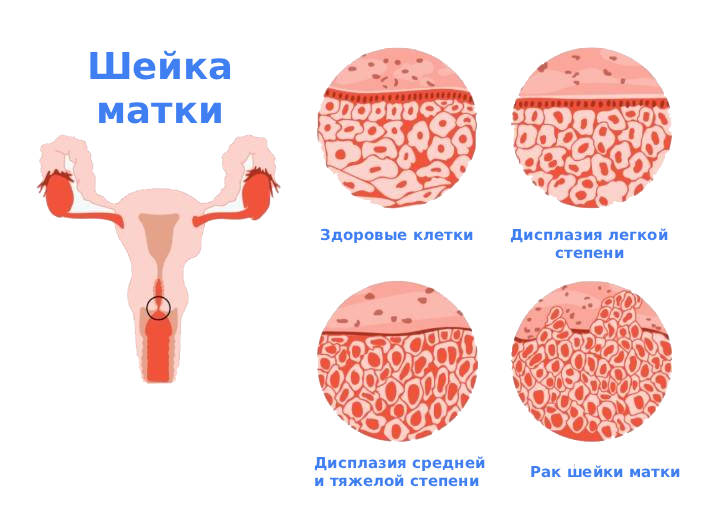 Cтепени дисплазии