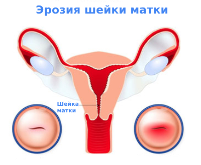 Эрозия шейки матки причины и лечение