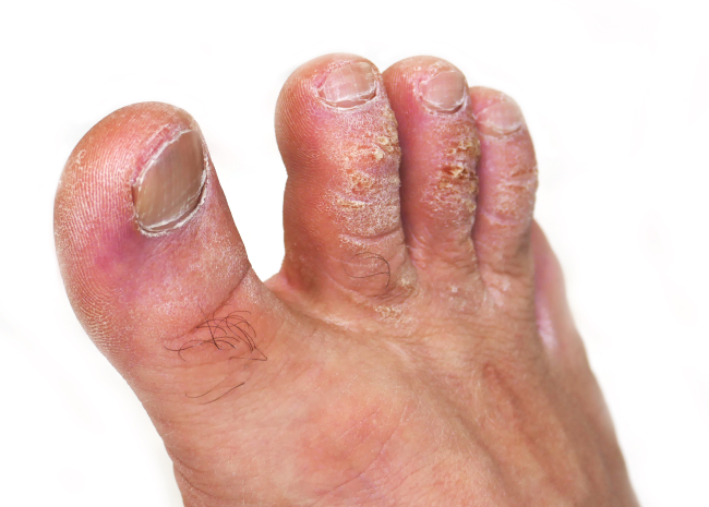 Гиперкаратоз - симптомы и лечение