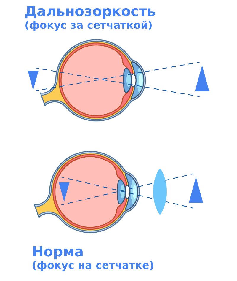 Гиперметропия