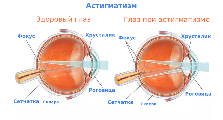 Астигматизм причины и лечение Астигматизм причины и лечение