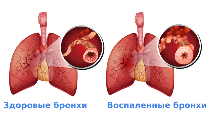 ХОБЛ симптомы и лечение у взрослых ХОБЛ симптомы и лечение у взрослых