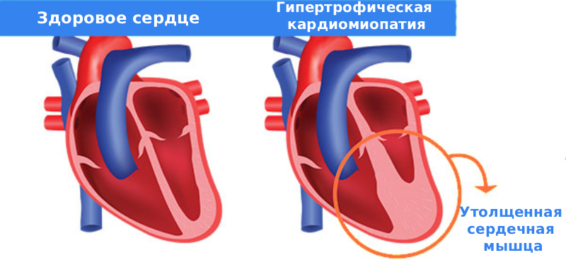 Признаки гипертрофической кардиомиопатии Признаки гипертрофической кардиомиопатии