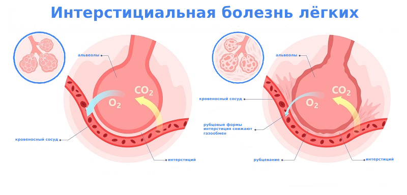 Интерстициальная болезнь легких лечение Интерстициальная болезнь легких лечение