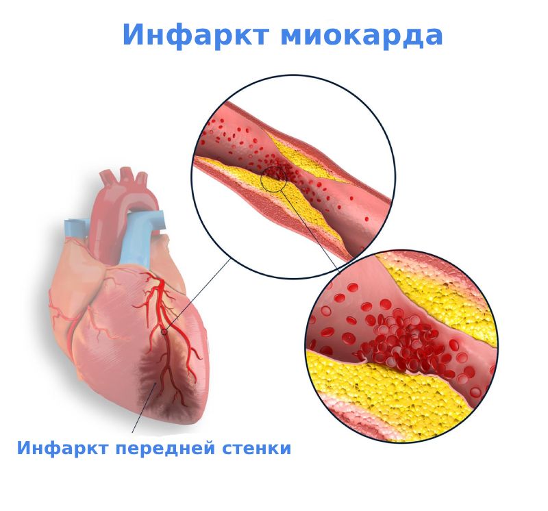 Инфаркт Инфаркт