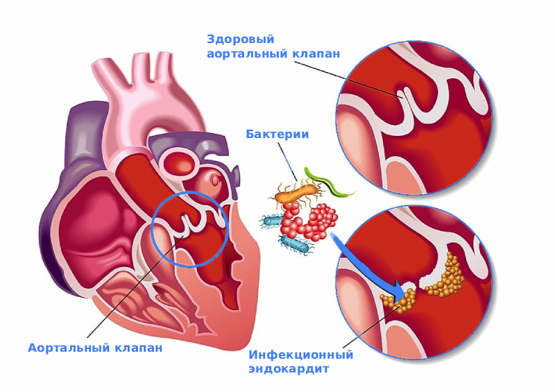 Инфекционный эндокардит симптомы Инфекционный эндокардит симптомы