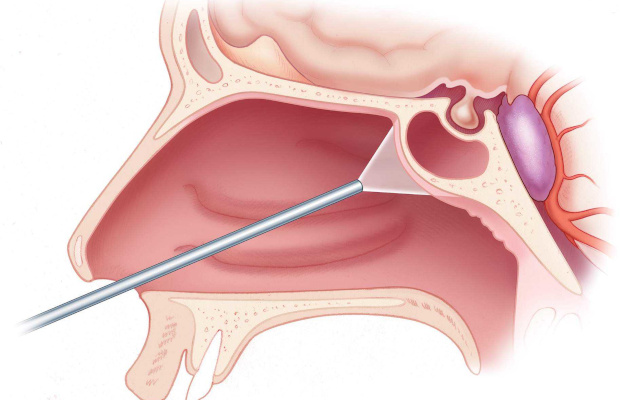 Киста в пазухе носа