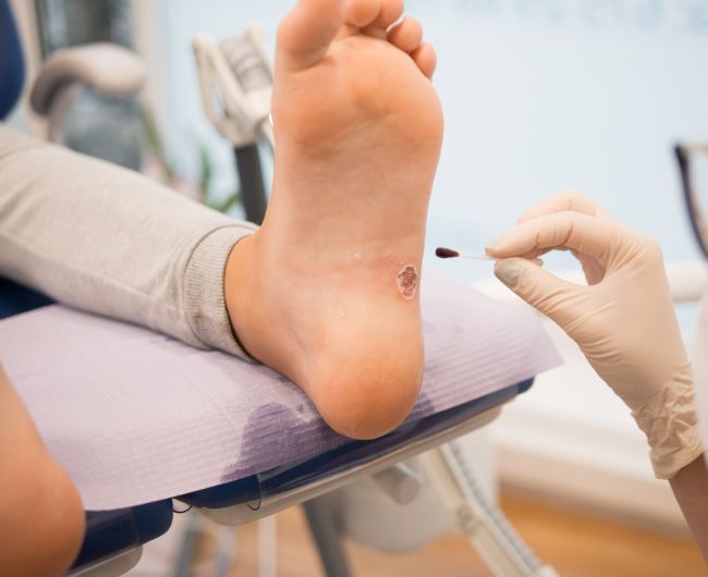 Лечение стержневой мозоли