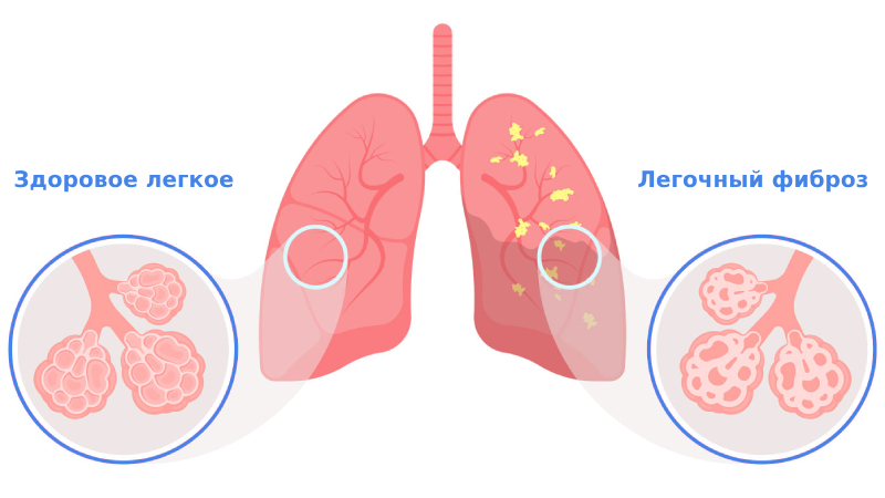 Фиброз легких симптомы и лечение Фиброз легких симптомы и лечение