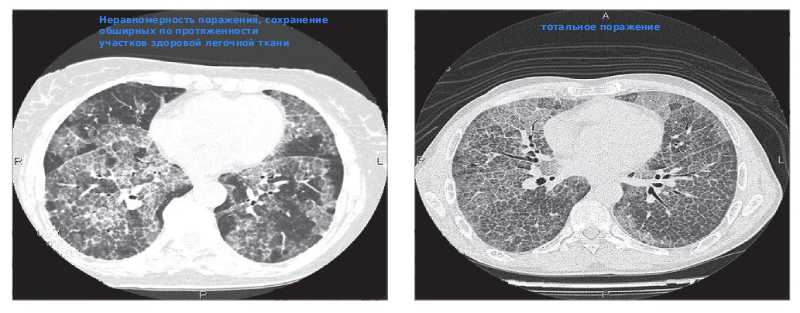 Легочный альвеолярный протеиноз Легочный альвеолярный протеиноз