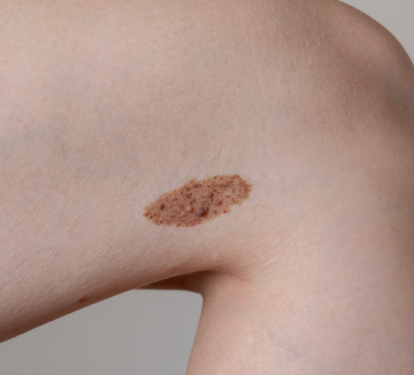 Родинка меланома