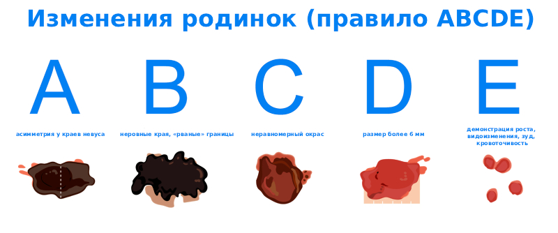 Меланома кожи - симптомы и признаки Меланома кожи - симптомы и признаки