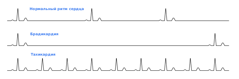 Виды аритмий сердца