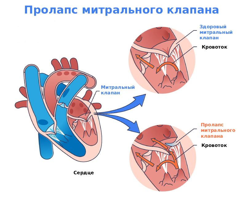 Пролапс митрального клапана сердца Пролапс митрального клапана сердца