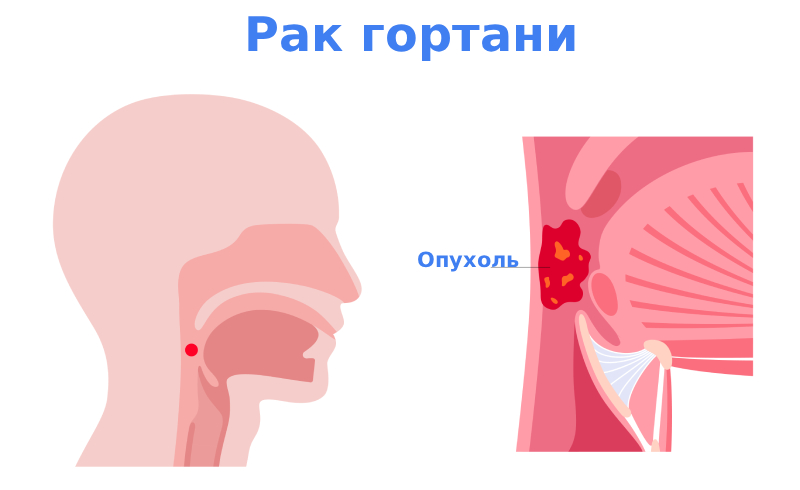 Рак гортани симптомы Рак гортани симптомы