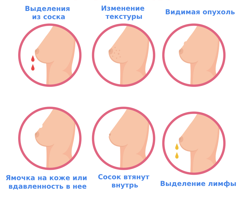 Симптомы рака груди