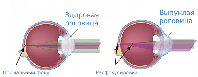 Астигматизм причины развития Астигматизм причины развития