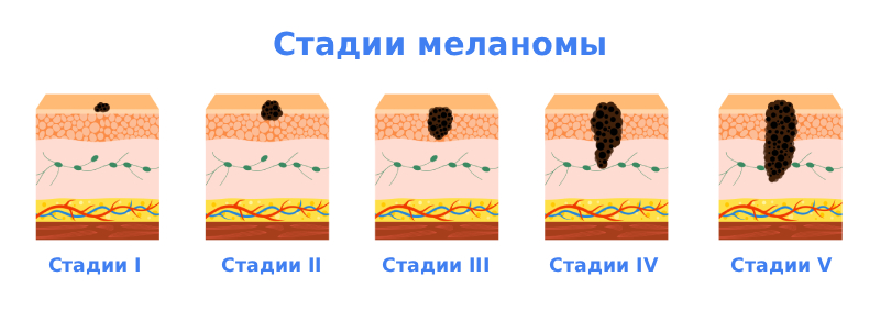 Стадии меланомы Стадии меланомы