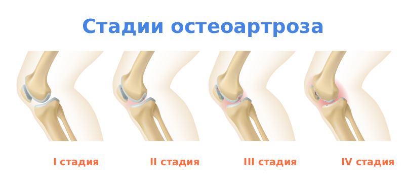 Степени остеоартроза