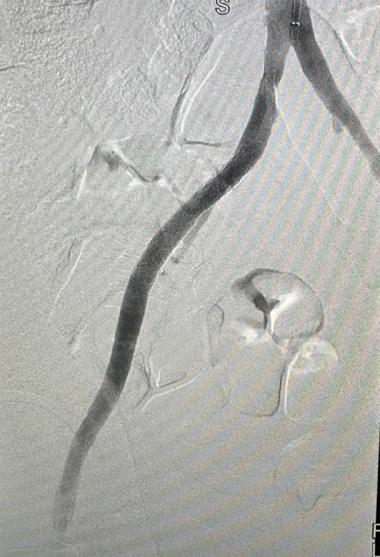 Стентирование - случай из практики