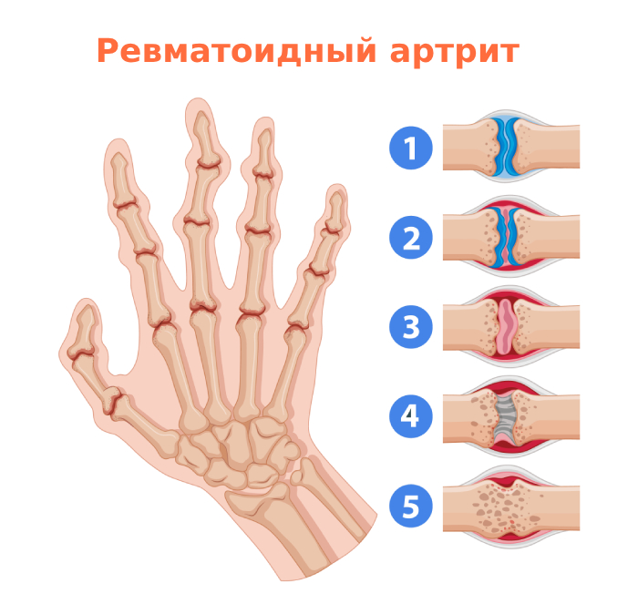 Ревматоидный артрит рук Ревматоидный артрит рук