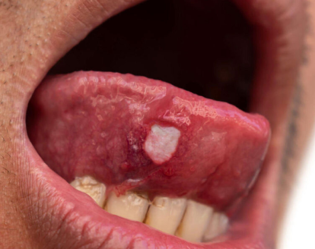 Злокачественные опухоли языка