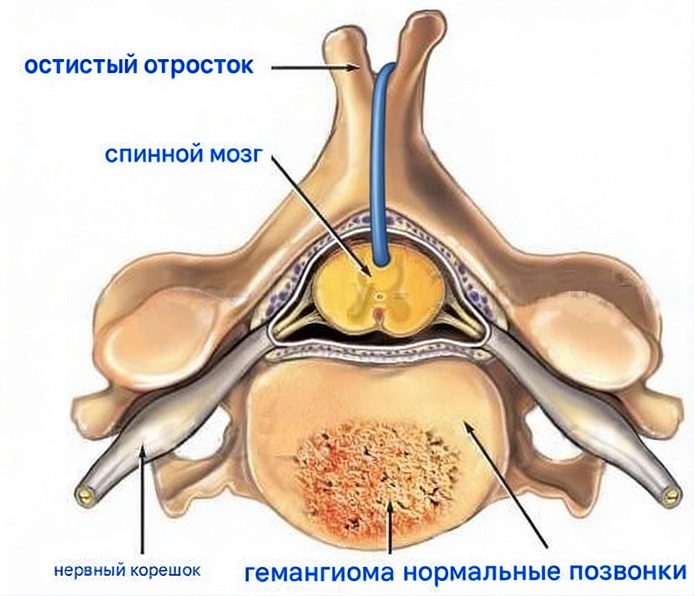 Гемангиома позвонка