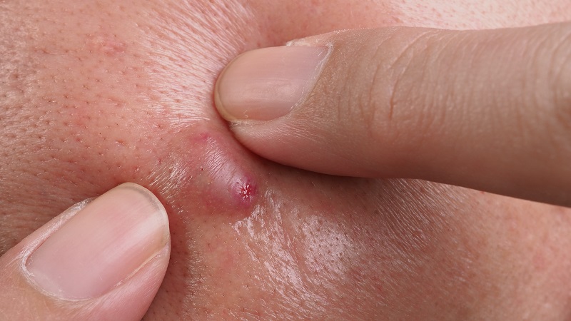 Гнойный абсцесс