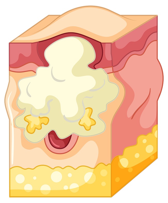 Абсцесс мягких тканей