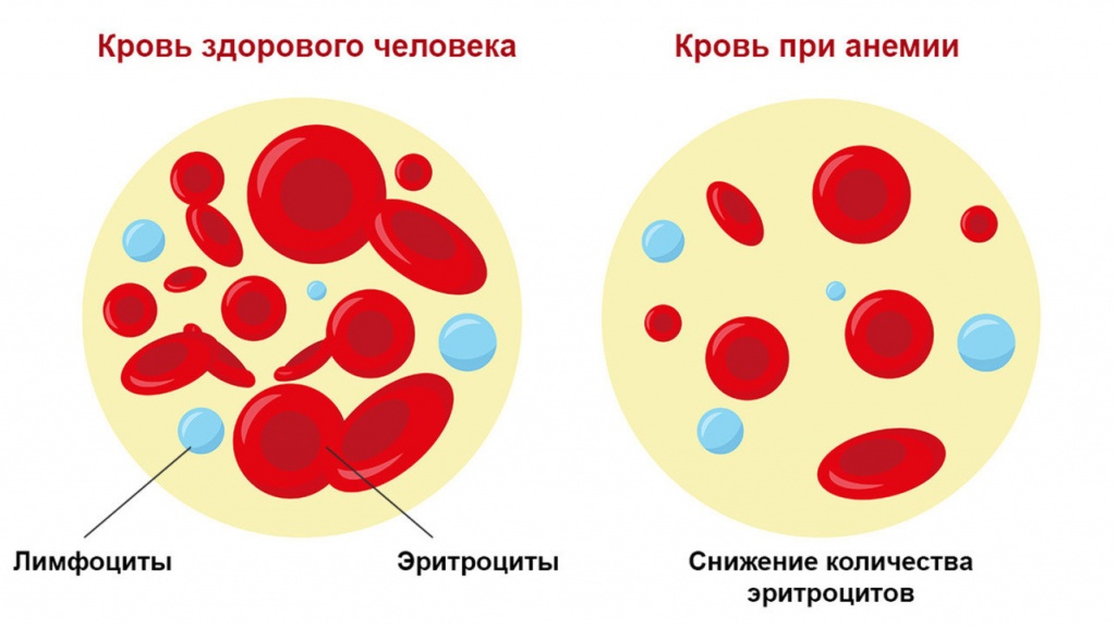 Анемия и другие болезни крови. Профилактика и методы лечения