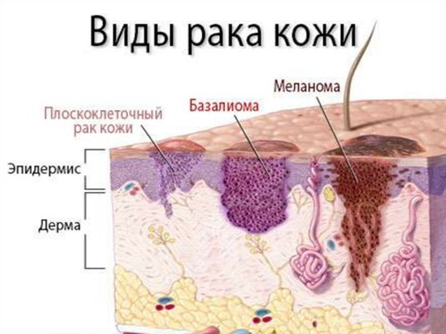 Базалиома – базальноклеточный рак кожи
