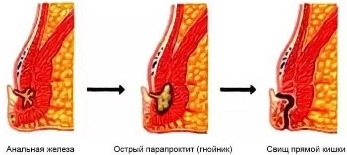Шишка в заднем проходе: диагностика и лечение в Казани